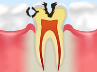 【C2】 象牙質の虫歯