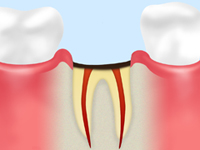 【C4】 歯根に達した虫歯
